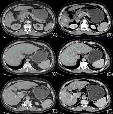 Computed tomography image quality in patients with primary hepatocellular carcinoma: intraindividual comparison of contrast agent concentrations